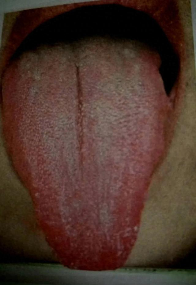 肝气郁结的人为何会舌头尖尖