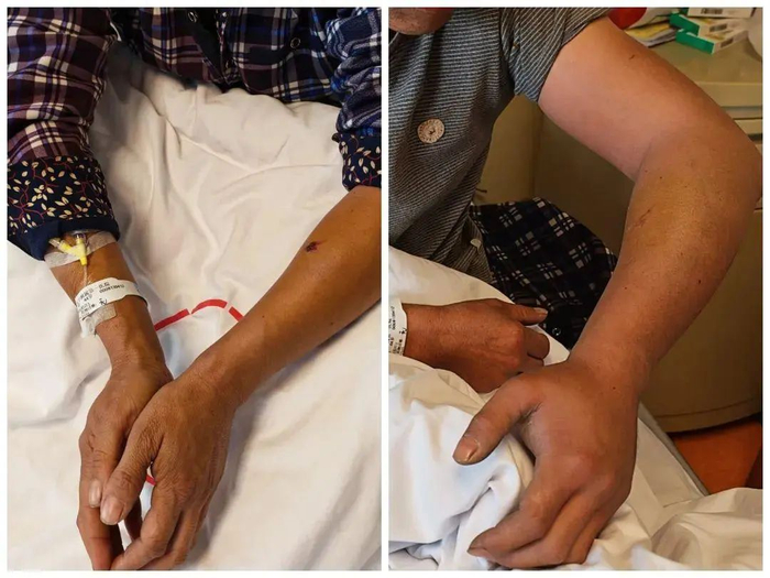 左图为用完血清恢复后；右图为刚入院时胳膊肿胀。图源：广州卫健委