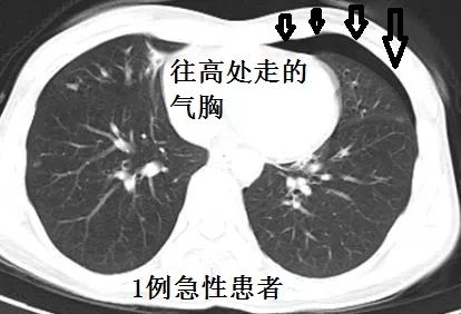 这样的气胸不少见,胸腔穿刺需谨慎!|气胸|胸腔|CT_新浪新闻