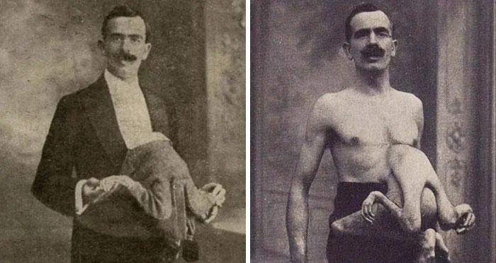 Jean Libbera，1884年出生于罗马，腹部附有寄生胎