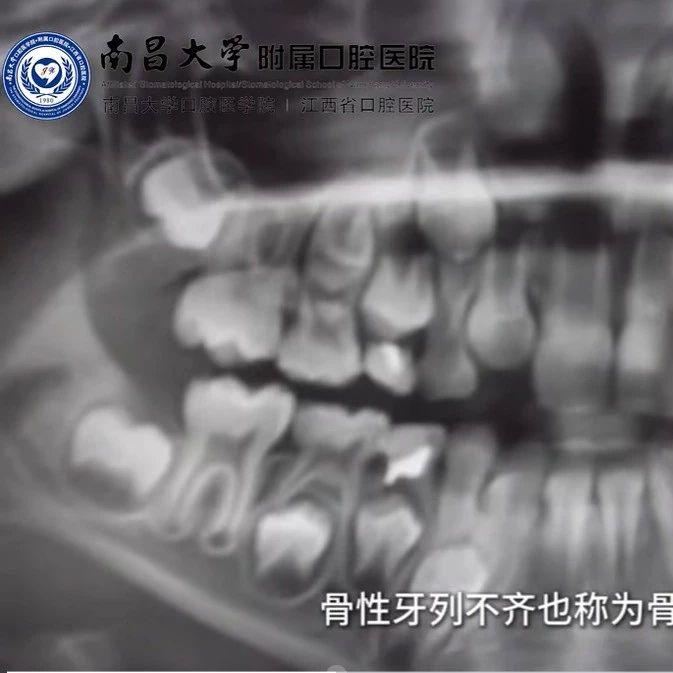 牙齿长歪怎么办？可以这样治疗→