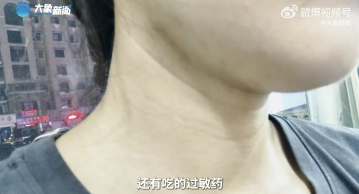 一些消费者通过社交平台也反映过使用可复美产品后面部出现肿胀问题。视频截图