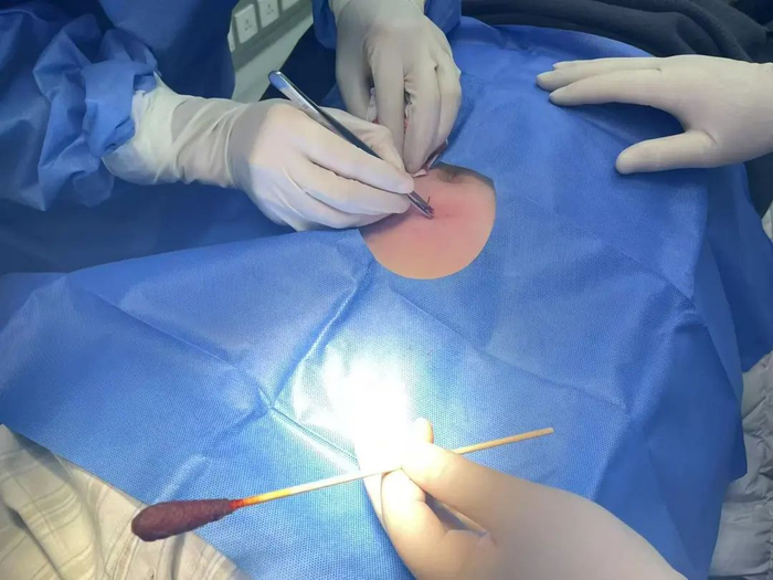 ▲“酒精芯片”手术，是在患者脐下的皮肤上切开1至2厘米的小切口，将盐酸纳曲酮药物埋植到皮下。受访者供图