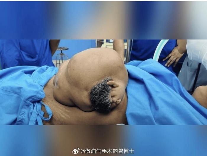 47岁女性手术切除背部寄生胎，含头部结构但无功能