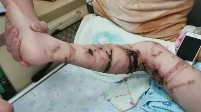 △被“咬”男孩的腿出现较大面积皮肤软组织坏死，小部分有感染迹象。