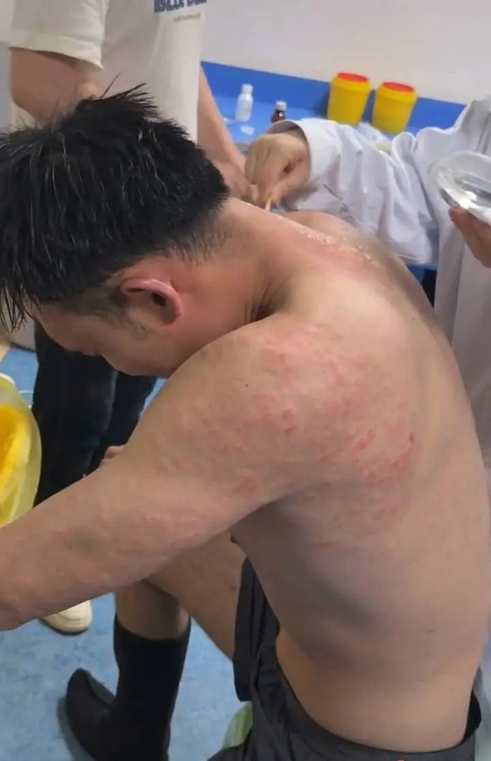 有演员的背部被冰雹砸红。视频截图