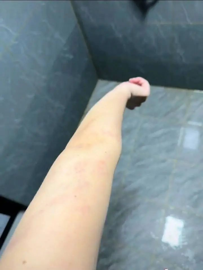 有演员的手臂被冰雹砸红。视频截图