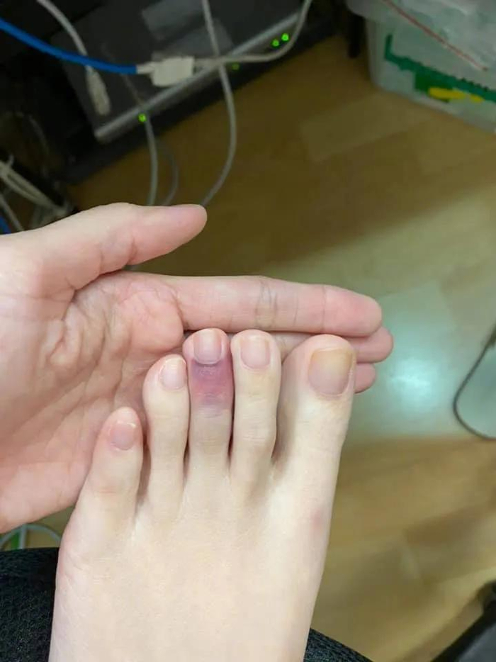 园长深夜发文脚趾被猫踩淤青,网友哭笑:什么体重的猫能伤你这样!