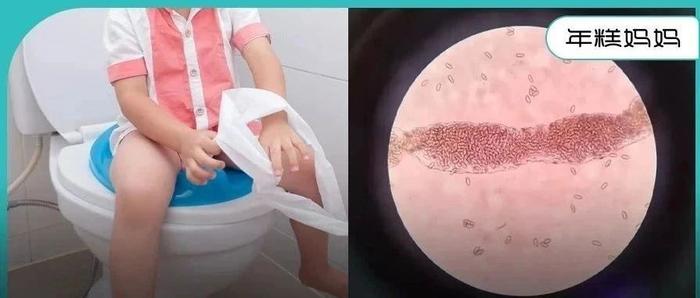 9岁男孩便便拉出活虫，竟然还在疯狂产卵！医生：夏天这个坏习惯该改改了