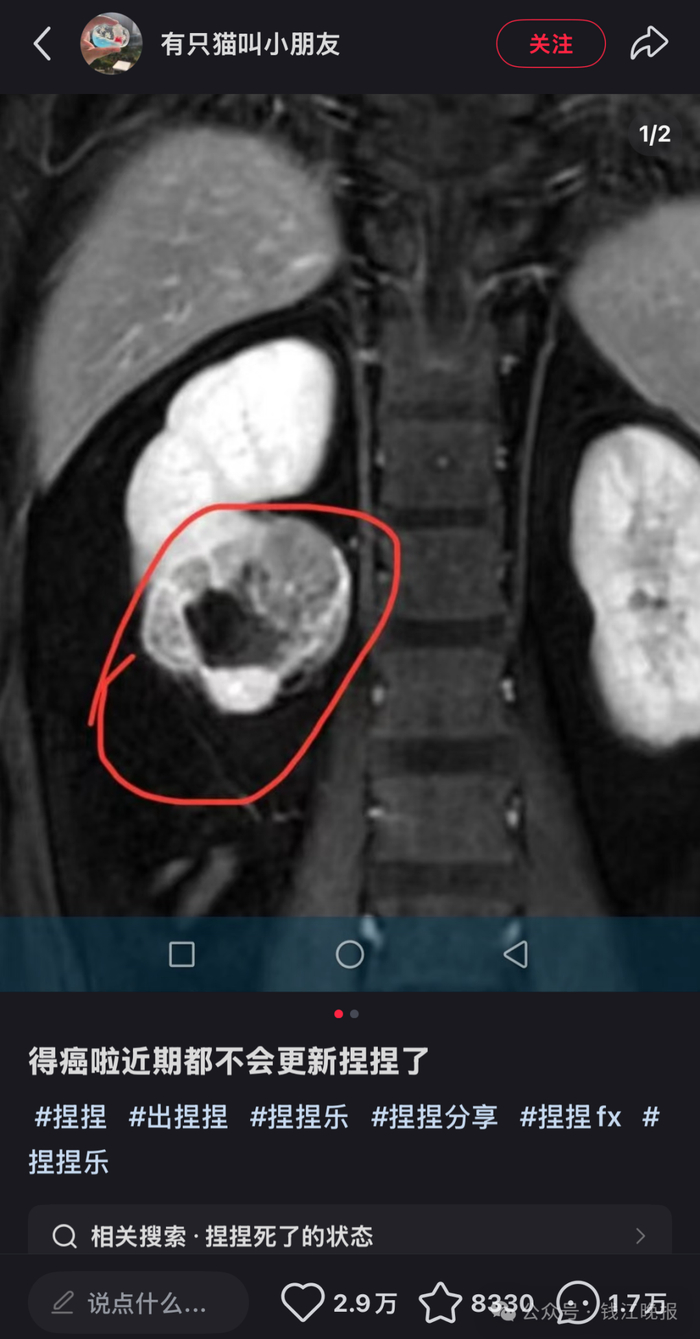 该博主在社交平台宣布罹患癌症。图源其账号截图
