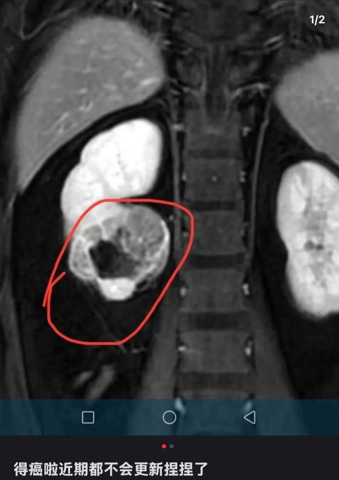 该博主在社交平台宣布罹患癌症。图源其账号截图
