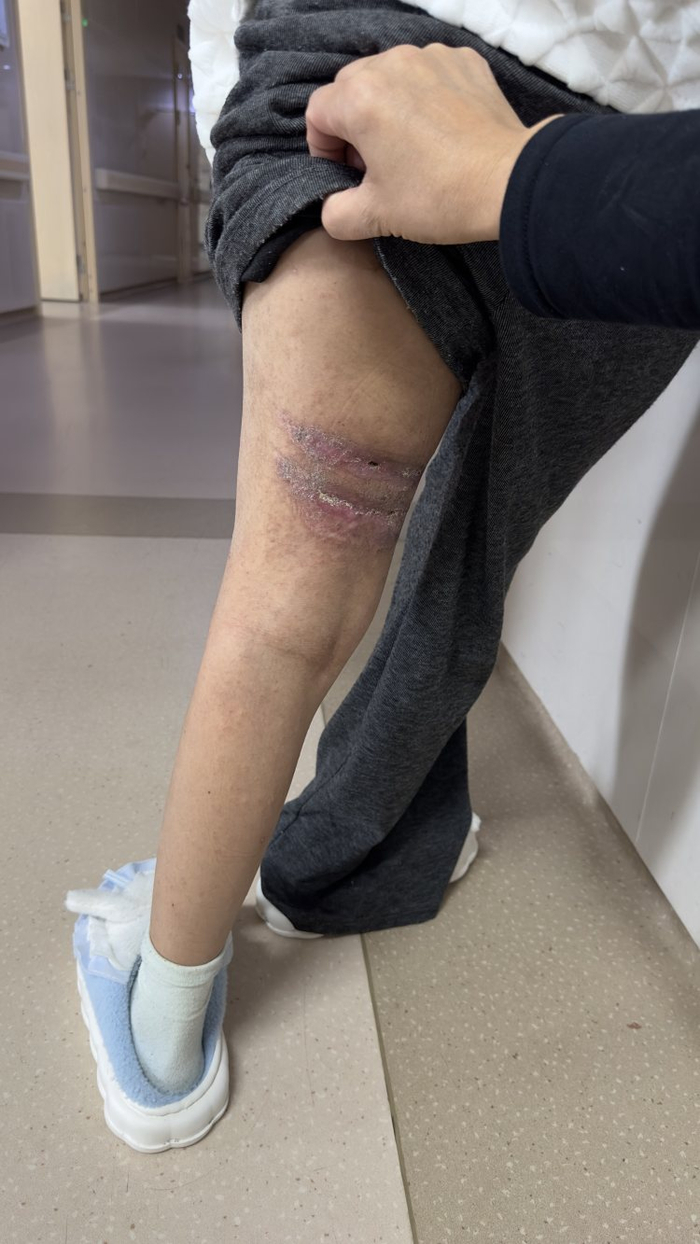 丹丹腿部遗留较大瘢痕。 受访者供图