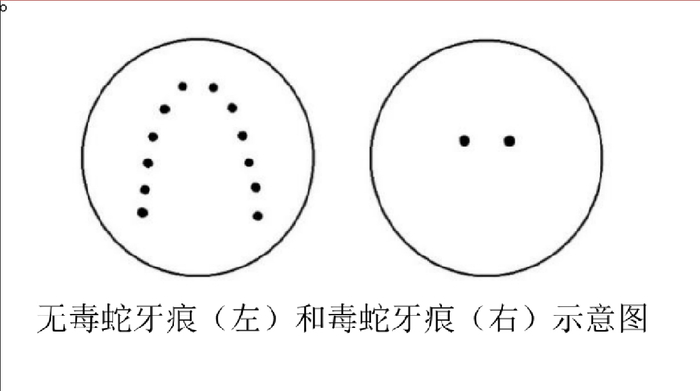 专家：毒蛇咬伤牙痕通常为2个，被咬后尽可能记清蛇特征或拍照