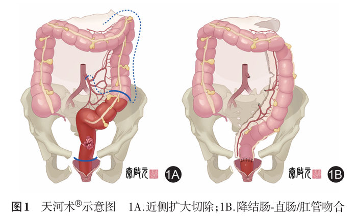 直肠癌放疗后保肛难题有解了!全国首个"天河术"操作标准出炉