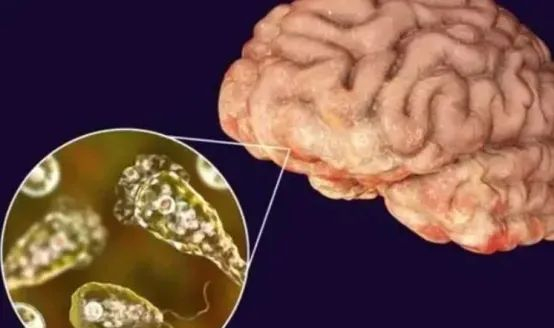 ▲食脑虫通常通过鼻腔进入大脑，引起脑实质损害。