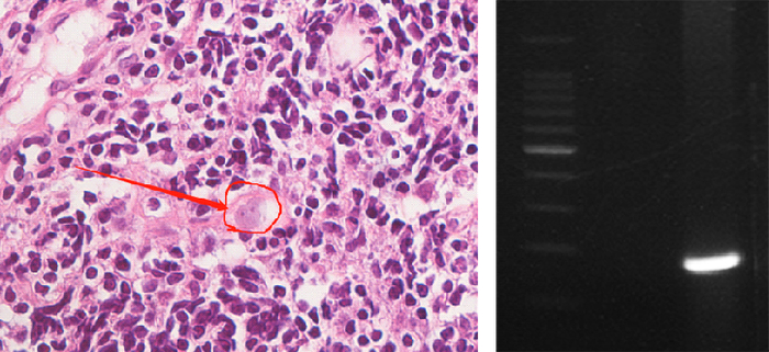 鼻组织显微镜下病理图（左）