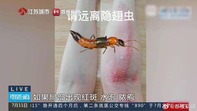 千万别拍!男子轻拍隐翅虫手臂现10厘米脓包