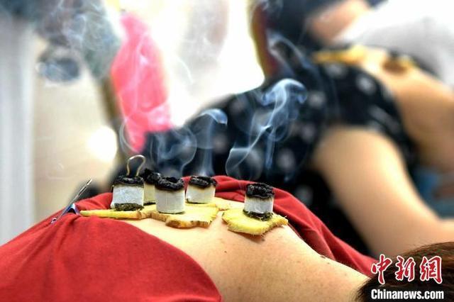 资料图:市民接受传统“三伏灸”治疗。 王东明 摄