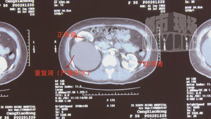 ct 检查显示,郑女士的的体内竟然有"三个肾",医学称之为重复肾