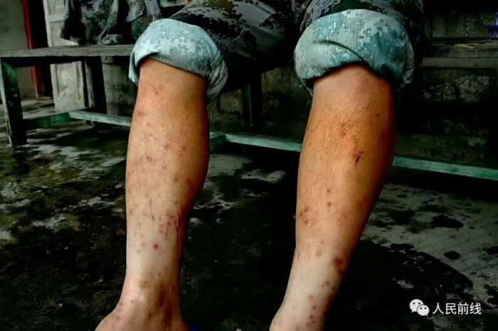 在墨脱县巡逻的解放军，蚂蝗叮咬留下的疤痕图自“人民前线”，2018年拍摄