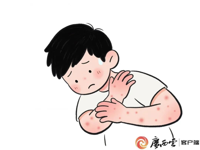 ▲伊蚊叮人引发过敏皮疹。广西云-广西日报记者 古秀芳绘制