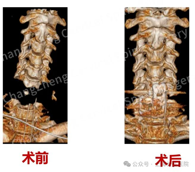 术前、术后影像对比，手术效果良好