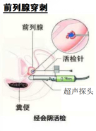 科普|前列腺穿刺活检安全吗?会不会引起肿瘤扩散?