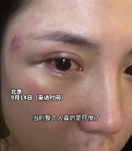 暖爆全网！冰雹砸伤女子两大哥冲上前护送 专家支招户外遇冰雹如何自救