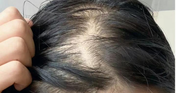一个土郎中说：脱发，不用2斤陈皮治不好