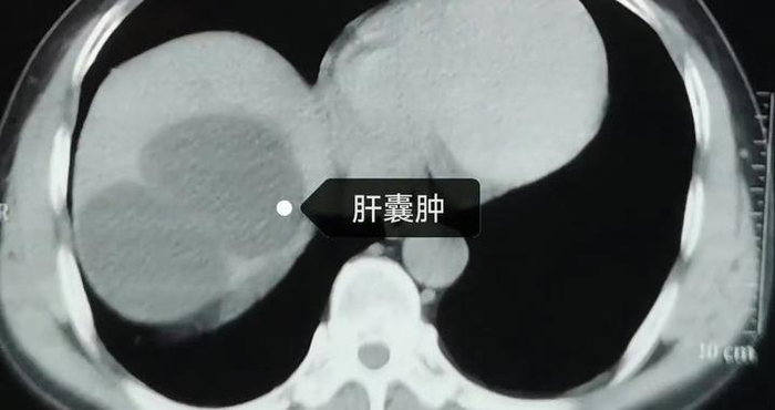 肝囊肿的本质，就是气不顺了，很多都不用做手术！