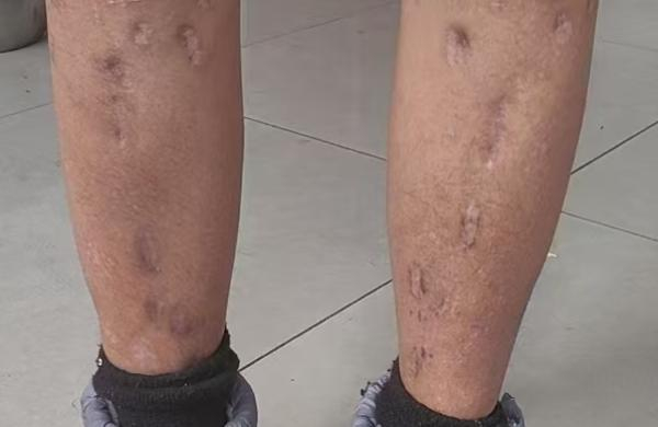 戴浩腿上术后留下的疤痕 （受访者提供）