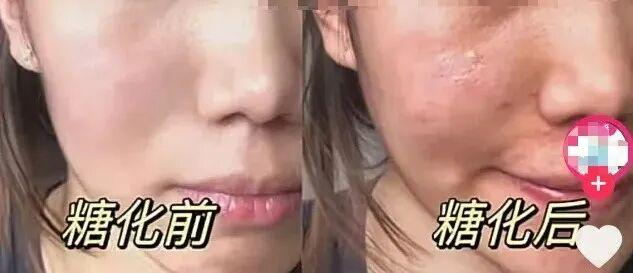 糖化脸前后对比。来源：新闻报道画面