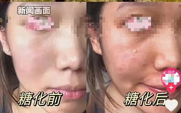 糖化脸前后对比。来源：新闻报道画面