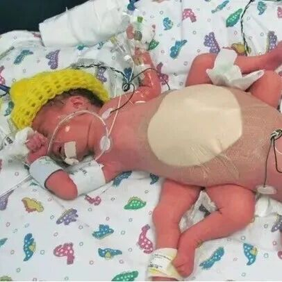 罕见同卵三胞胎中，有俩是更罕见连体婴？！战胜1/5千万概率，成功分离！