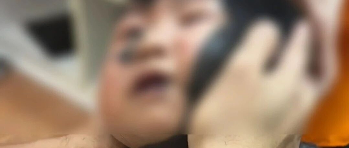 产检全通过，宝宝却带“兽皮痣”出生，为何产检难发现？