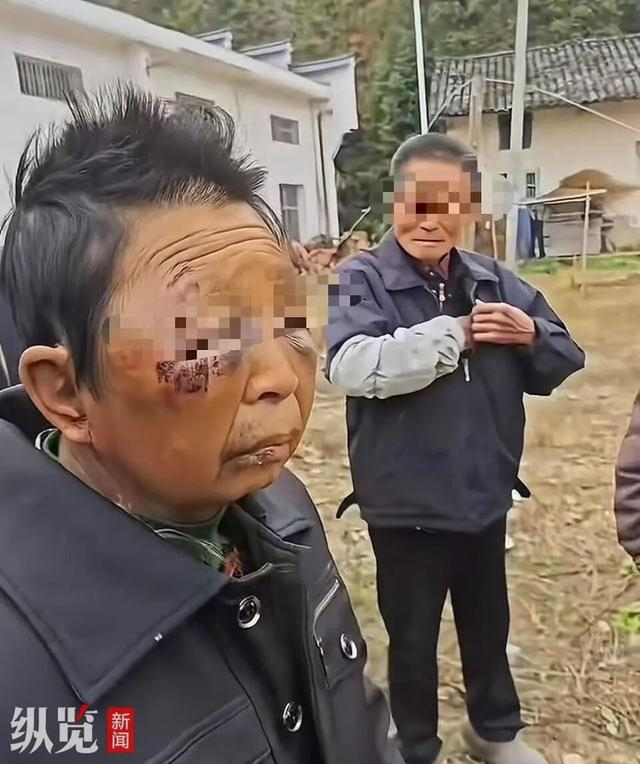 一名妇女面部有多处淤青，一只眼无法睁开。（来源/网络截图）