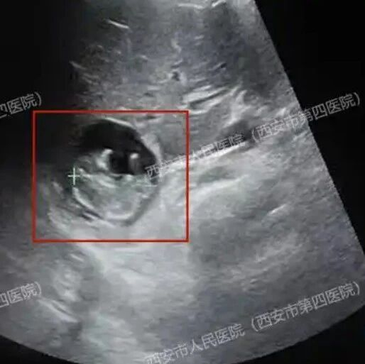 极其罕见！女子怀孕后检查发现，子宫内不见胎儿？