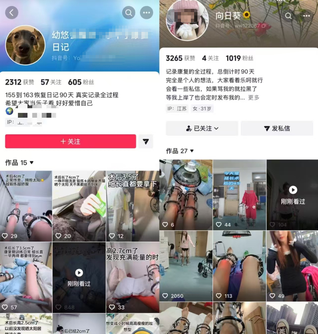 抖音上相關(guān)用戶(hù)分享“斷骨增高”手術(shù)后恢復記錄的相關(guān)主頁(yè)（截圖）
