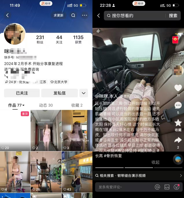 抖音上相關(guān)用戶(hù)分享“斷骨增高”手術(shù)后恢復記錄的相關(guān)主頁(yè)（截圖）