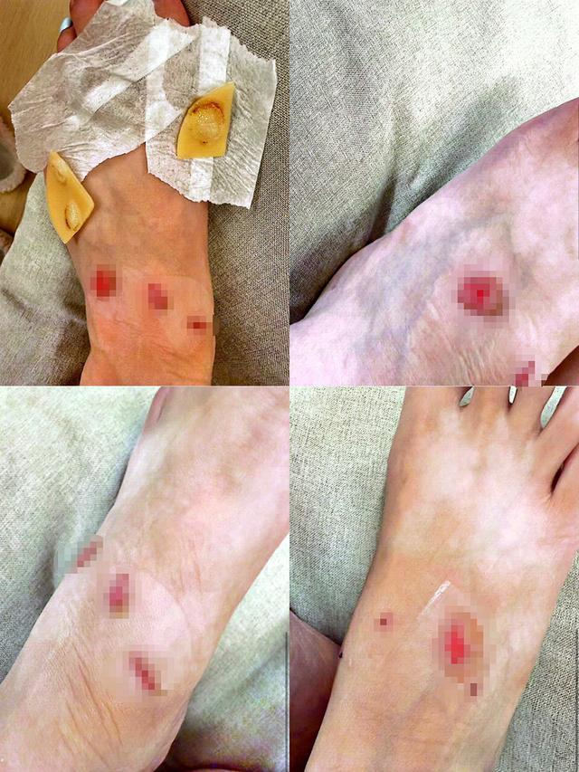 徐女士脚背部磨损图
