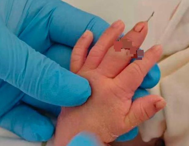 快评 | 新生儿手指被当成脐带剪断！只是助产士的问题？