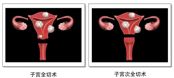 子宫已经切除,宫颈癌筛查还有必要做吗?|手术|子宫切除术|妇科|子宫颈癌|宫颈病变_新浪新闻
