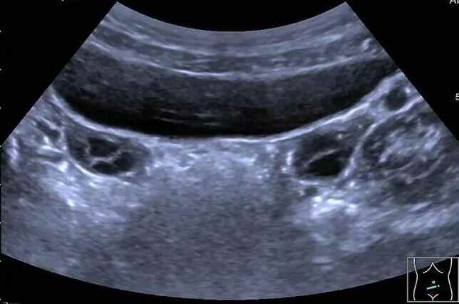 7岁女童3个月猛蹿4cm，检查后发现“乳腺发育、子宫及卵巢体积增大”，被确诊性早熟，医生提醒→