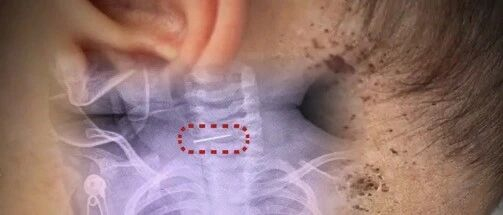 10个月大男婴被母亲扎数百针