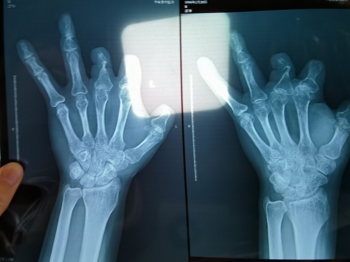 2021年12月，患者彭先生拍摄的左手X光片，未见收费单据中列出的微血管吻合装置。新京报记者 程亚龙 摄