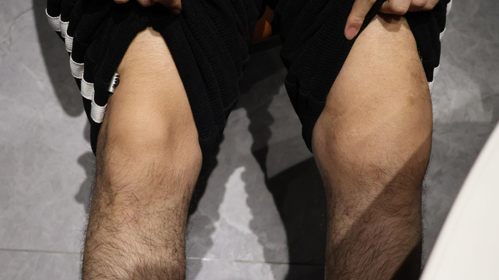 叶胜乐左腿膝盖肿胀，医生判断为出血。新京报记者 黄依琳 摄 