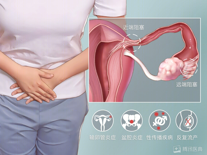 输卵管疾病示意