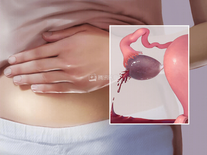 卵巢巧克力囊肿示意