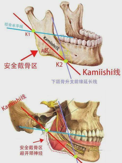 如何拥有好看的下颌线|下颌骨|下颌手术|支撑性|颏神经|延长线_新浪新闻