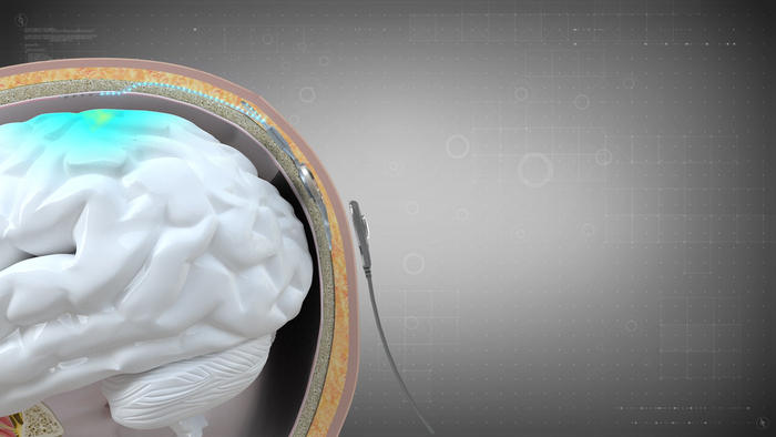 获批上市的首款侵入式脑机接口医疗器械示意图。受访者供图